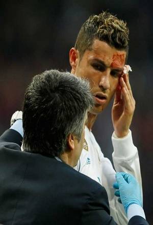 VIDEO: Cristiano Ronaldo salió cortado del rostro ante La Coruña