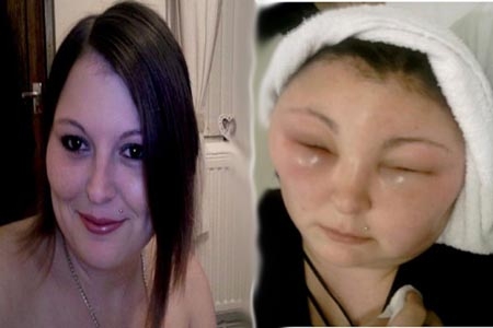 Tinte de cabello dejó desfigurada y ciega a una mujer