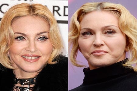 Madonna aparece con el rostro operado