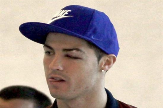 Cristiano Ronaldo presume golpe en el ojo