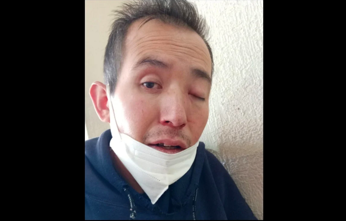 Muere el primer infectado por hongo negro en México