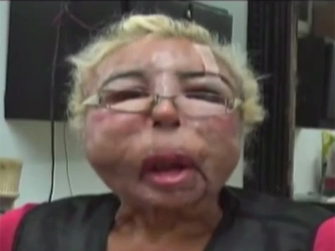 VIDEO: Hombre deformó su rostro por lucir siempre joven