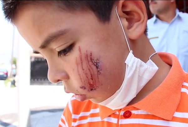 VIDEO: Pitbull muerde en el rostro a niño de 8 años en Saltillo