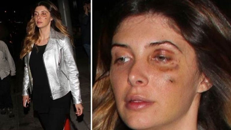 Ex novia de Luis Miguel recibió golpiza en Hollywood