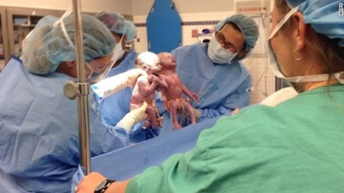 Gemelas nacieron tomadas de la mano en EU