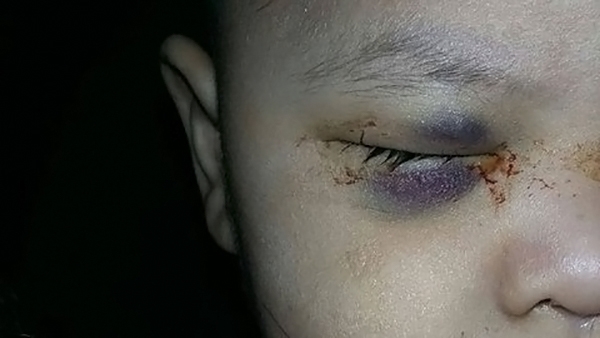 Por negligencia, médicos del IMSS le sacan ojo a bebé de un año