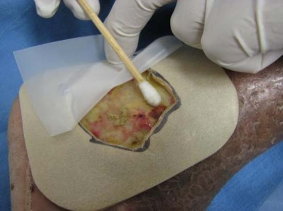 Larvaterapia para tratar pie diabético y otras heridas