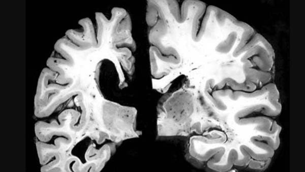 Advierte IMSS Puebla casos de Alzheimer a temprana edad