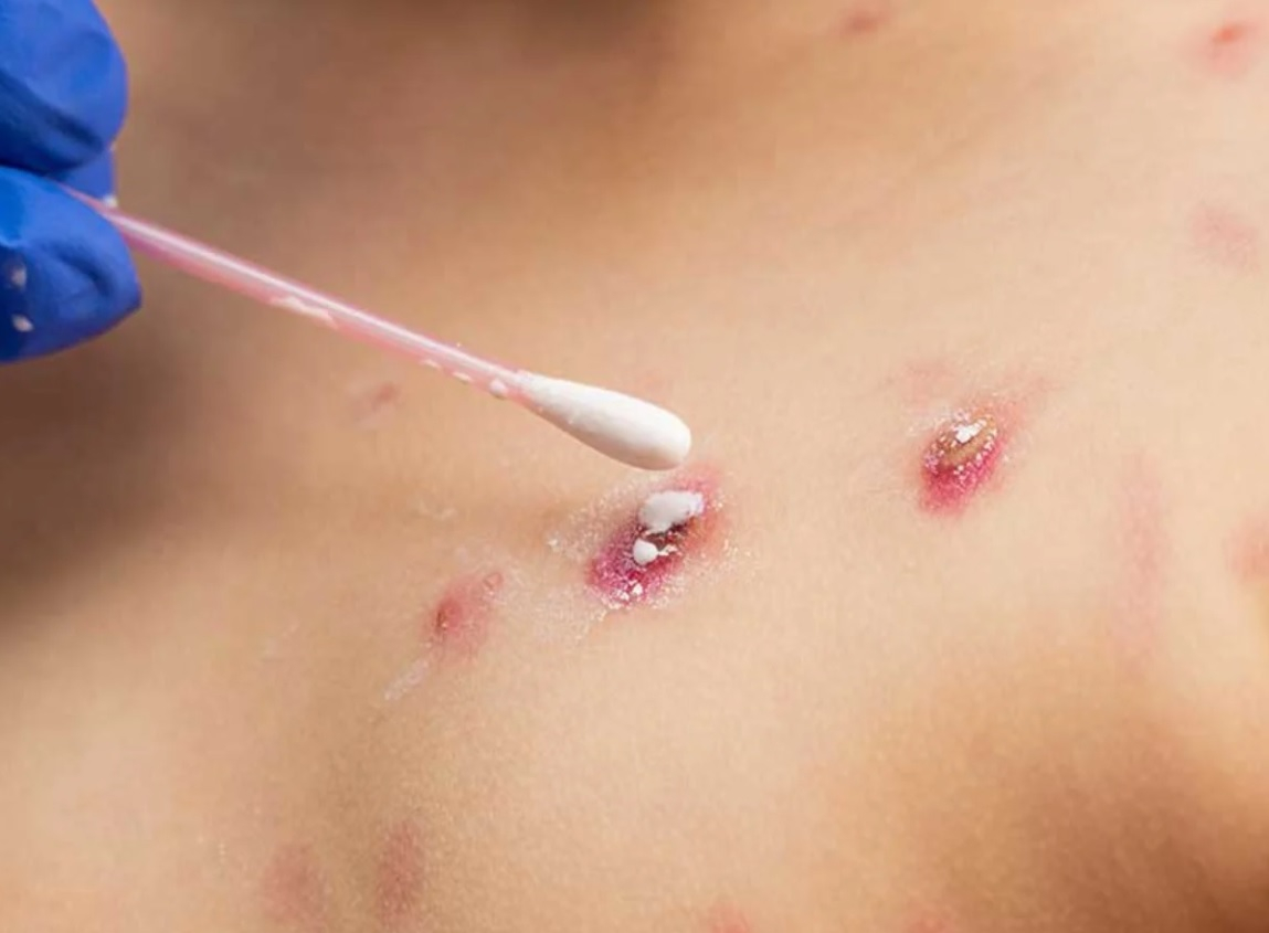 Salud emite aviso epidemiológico por viruela del mono