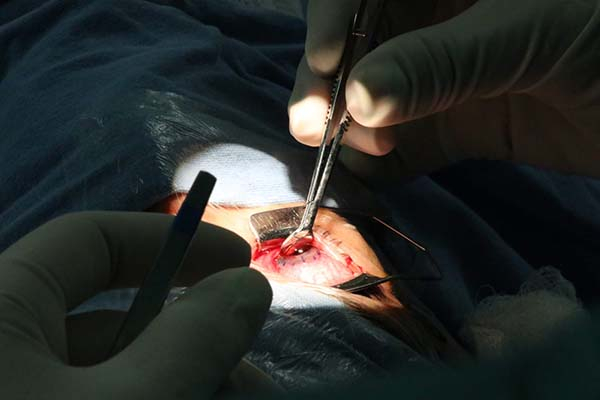 ISSSTEP realizó dos trasplantes de córnea gracias a donación cadavérica