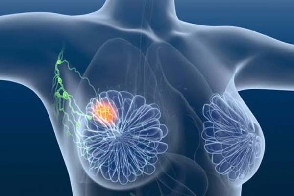 A la semana detectan a tres mujeres con tumor maligno de mama en Puebla
