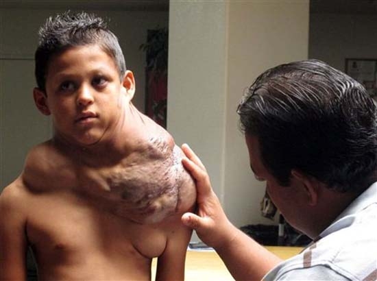 Extirpan enorme tumor a niño mexicano en Nuevo México