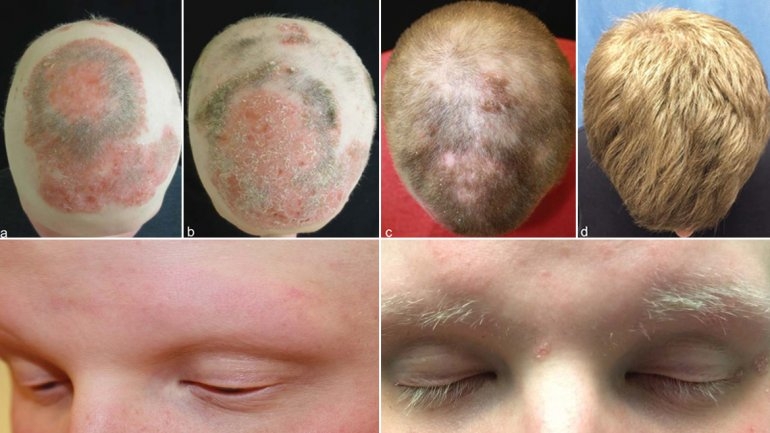 Droga contra artitris hace crecer el cabello