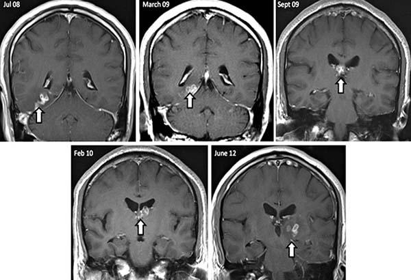 Le dolía la cabeza; el doctor le encuentra un gusano en el cerebro