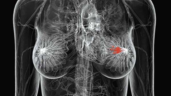 Aumentan casos de cáncer de mama en mujeres jóvenes: IMSS Puebla