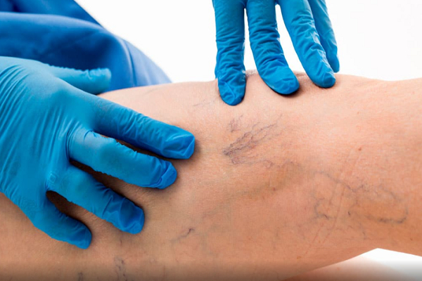 Varices: Conoce cómo eliminarlas sin recurrir a la cirugía