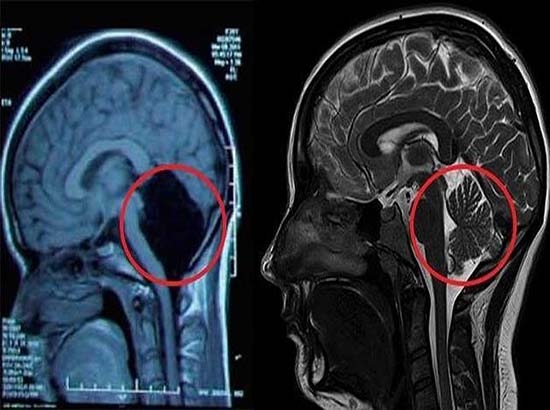Sorprende a médicos caso de china de 24 años sin cerebelo