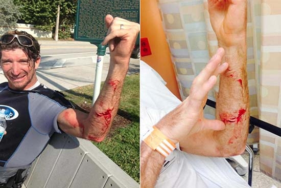 Tiburón muerde más de 10 veces el brazo de un surfista en Florida