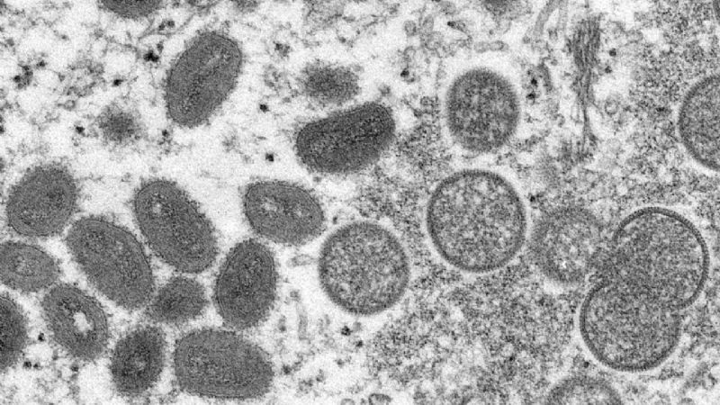Registran primer caso de viruela del mono en México