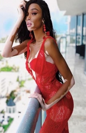 Winnie Harlow, modelo con vitiligo, estará en desfile de Victoria´s Secret
