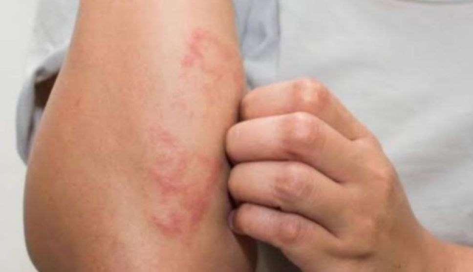 En cinco años, nueve casos de lepra en Puebla; no hay alerta