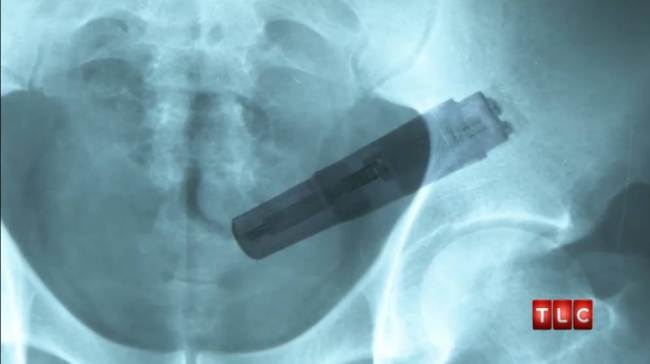 Hallan vibrador en intestino de un paciente en EU