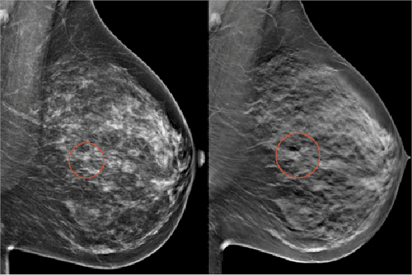 A la semana tres poblanas reciben diagnóstico de tumor maligno de mama