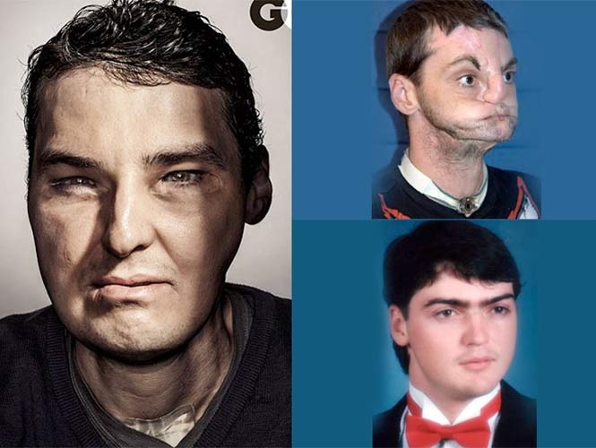 Richard Norris, hombre con transplante de rostro en la portada de GQ