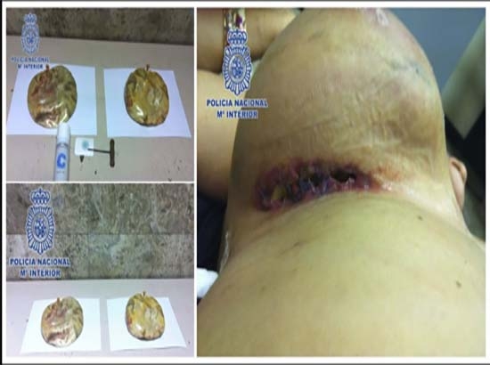 Mujer traficaba cocaína en implantes mamarios; la detuvieron en España