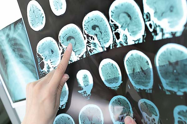 Se disparan 25% casos de Alzheimer en Puebla