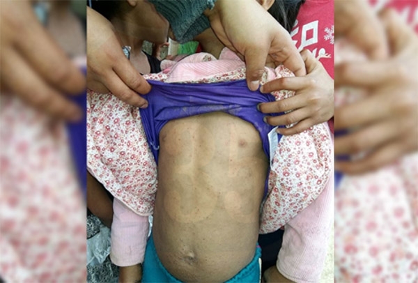 Suspenden atención para 40 niños con sarna en Oaxaca