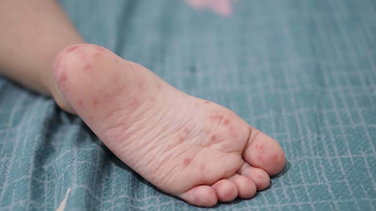 Alerta por brote de virus Coxsackie en primaria de Puebla capital